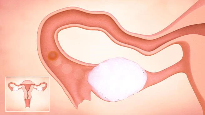 Graphic of female uterus